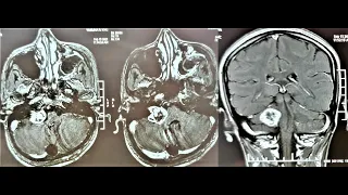 VESTIBULAR SCHWANNOMA-MICROSURGERY- POST GAMA KNIFE TREATMENT-dr suresh dugani/HUBLI/KARNATAKA/INDIA