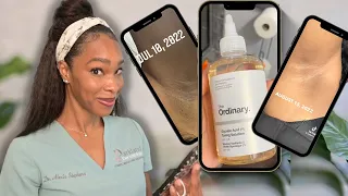 Glycolic Acid as a deodorant and hyperpigmentation hack?