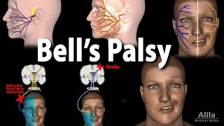 Bell's Palsy, Pathophysiology, Symptoms, Diagnosis and Treatment, Animation