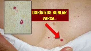 DİQQƏT!!! sizdə bu 10 əlamətdən biri varsa, Ürəyiniz düz işləmir - SONA QƏDƏR