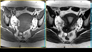 Female Pelvis Imaging - Pulsing Sequences Introduction T1 on MRI