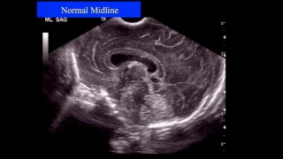 Neonatal Neurosonography   The Premature Infant