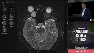 Orbital Cavernous Malformation - Radiology Review Course