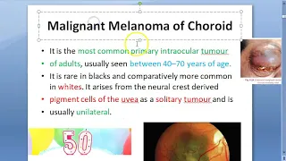 Ophthalmology Malignant Melanoma Choroid