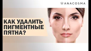 ЭТО ВАЖНО ЗНАТЬ ❗️ УДАЛЕНИЕ ПИГМЕНТНЫХ ПЯТЕН 🔥 ANACOSMA