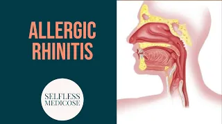 ALLERGIC RHINITIS complete explanation part 2