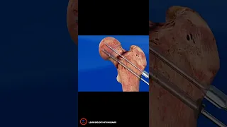 Orthopedic Hip Procedure Animation - #shortsvideo