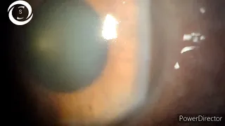 Microcytic corneal edema in Glaucoma