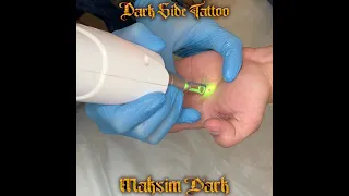 Удаление тату на ладони. Тату студия «Dark Side Tattoo» г. Воронеж