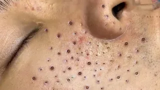 Remove Blackheads and Hidden Acne At Loan Nguyen Spa #111