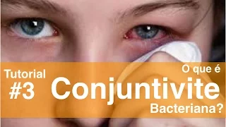 Conjunctivitis tutorial #3 - Bacterial Conjunctivitis