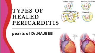 Pericarditis | types of HEALED pericarditis | cardiology | medinject