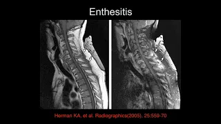 Cervical Inflammation