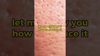 Suffering from textured skin?