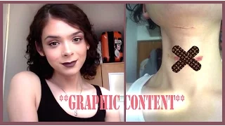 Plastic Surgery Vlog (**GRAPHIC CONTENT**) | Samantha Lux