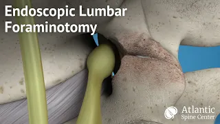 Endoscopic Lumbar Foraminotomy