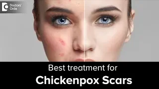 Get rid of skin scars after chickenpox - Dr Rajdeep Mysore | Doctors' Circle