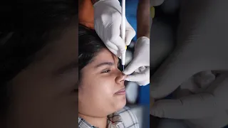 Mole Removal | Get rid of moles with laser | Mole Removal #shortsvideo