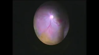 A Case Report on Removal of a Large Intraocular Foreign Body Part of a Spoon from Posterior Segment