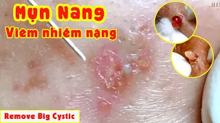 Điều trị mụn hiệu quả TPHCM | Hiền Vân spa | Remove Big Cystic | Acne Treatment | Đỗ Thu Hiền | 618