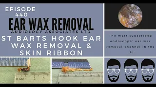 ST BARTS HOOK EAR WAX REMOVAL & SKIN RIBBON - EP440