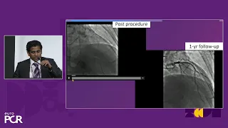 Sirolimus-coated balloon: expanding the scope of indications for complex CAD treatment - EuroPCR