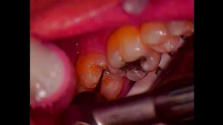 Dan's Tooth Decay Hiding Under An Old Filling