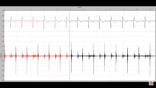 Holosystolic murmur in a child with a membranous ventricular septal defect