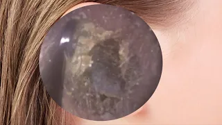 Doctor MON ear wax removal compilation videos Ep 37