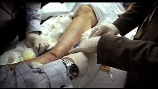 Worst Ankle Fracture (Part 2) - Bizarre ER