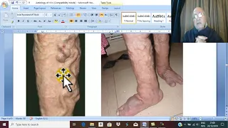 Venous Disorders in English 9 ( Varicose veins , aetiology ) , by Dr.Wahdan