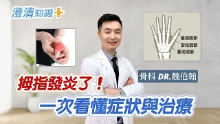 【澄清知識＋】拇指發炎了！一次看懂症狀與治療 -骨科 魏伯翰醫師
