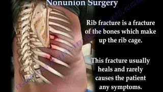 Rib Fracture Nonunion Surgery - Everything You Need To Know - Dr. Nabil Ebraheim