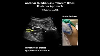 Anterior quadratus lumborum block, posterior approach