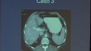 Marcadores tumorales en gastroenterología: cuando pedirlos y cómo interpretarlos