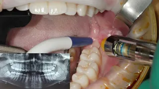 A mixed approach: traditional and piezoelectric extraction protocol