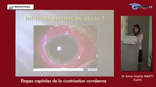 Etapes capitales de la cicatrisation cornéenne - Dr MARTY Anne-Sophie