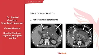 Cirugía general Vill - Pancreatitis Aguda