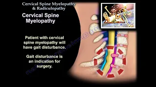 Cervical Spine Myelopathy & Radiculopathy - Everything You Need To Know - Dr. Nabil Ebraheim