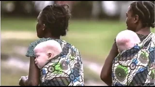 Situación de los albinos en África