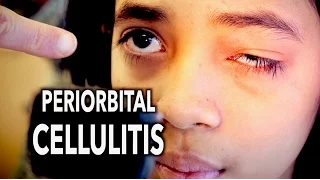 PERIORBITAL CELLULITIS (Painful!) | Dr. Paul