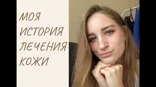 КАК Я ВЫЛЕЧИЛА КОЖУ, ПРИЧИНЫ ПОЯВЛЕНИЯ АКНЕ