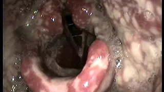 Disseminated gonorrhea: scattered fibrinous lesions in the pharynx and larynx