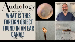 WHAT IS THIS FOREIGN OBJECT FOUND IN AN EAR CANAL? - EP572