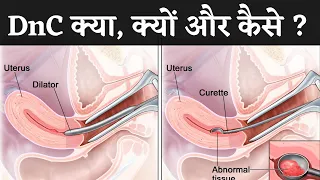 D&C के कितने दिन बाद period आता है | D&C कब और कैसे की जाती है | D&C in Jaipur