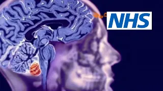 Benign brain tumour: Debbie's story | NHS