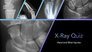 X-ray Quiz: Hand and Wrist Injuries