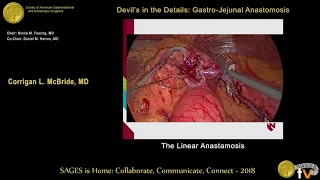 Devils in the Details-Linear stapled gastro jejunostomy