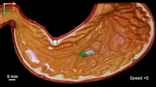 Robot clears foreign body from stomach CREDIT Wang and Pan et al