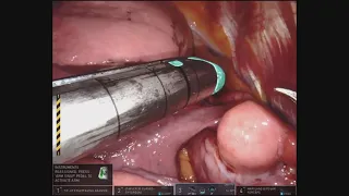 Robotic Resection of Solitary Fibrous Tumor